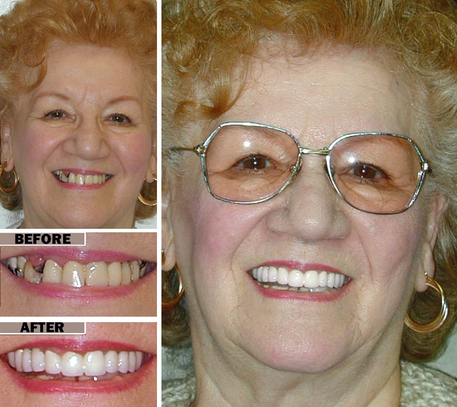 Implants Dentures Saint Johnsbury VT 5819